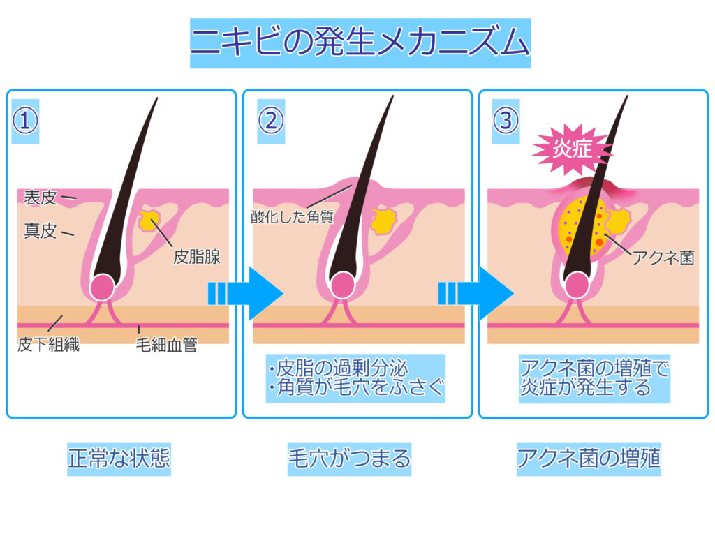 ニキビ発生のメカニズムの図