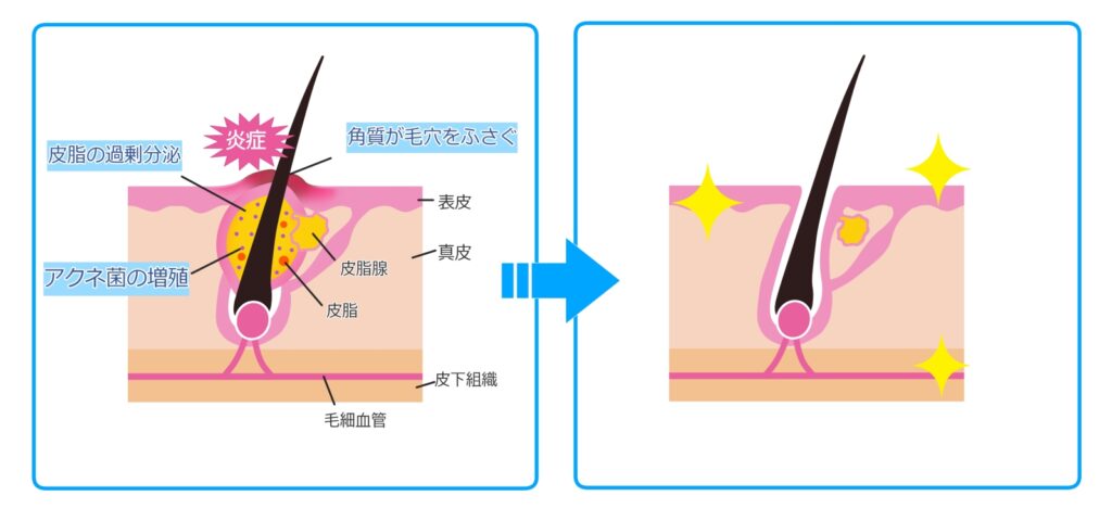 ニキビとピーリングの関係を示した図