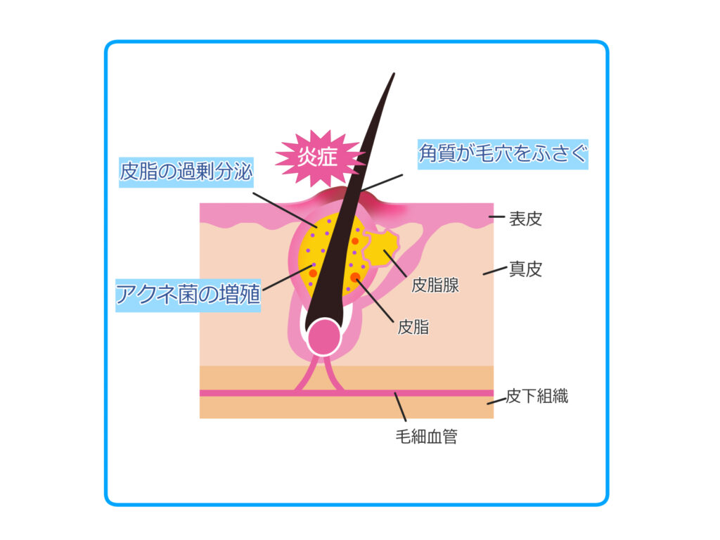 角質が毛穴を塞いで、皮脂が過剰分泌されて、アクネ菌が増殖しているのを表したニキビの模式図