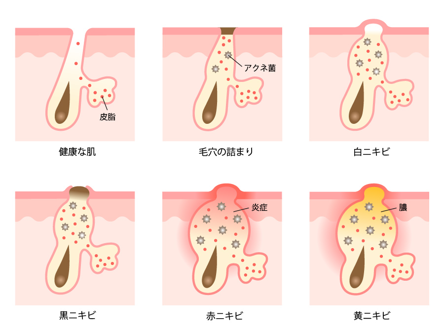 健康な肌、毛穴の詰まり、白ニキビ、黒ニキビ、赤ニキビ、黄ニキビを模式的に表した図